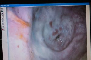 stomach ulcers in a horse via endoscopy