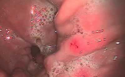 What are Gastric Ulcers?